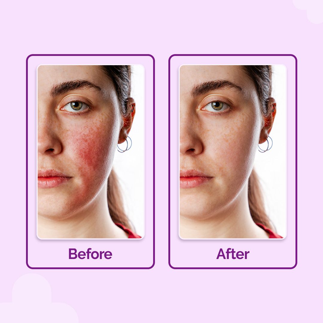 Hypochlorous Anti-Acne Hydrating Spray - 200ml